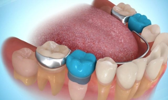 apparecchi ortodontici mobili